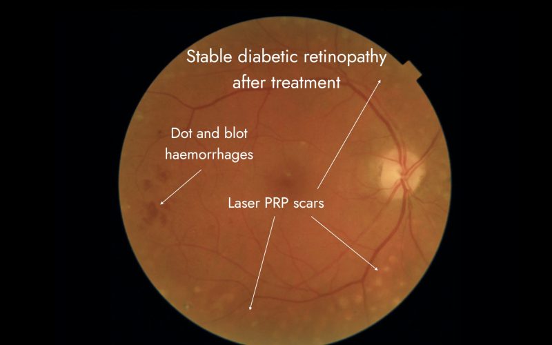 60a2c6737b4a321c4b78fda9_stable diabetic retinopathy after treatment