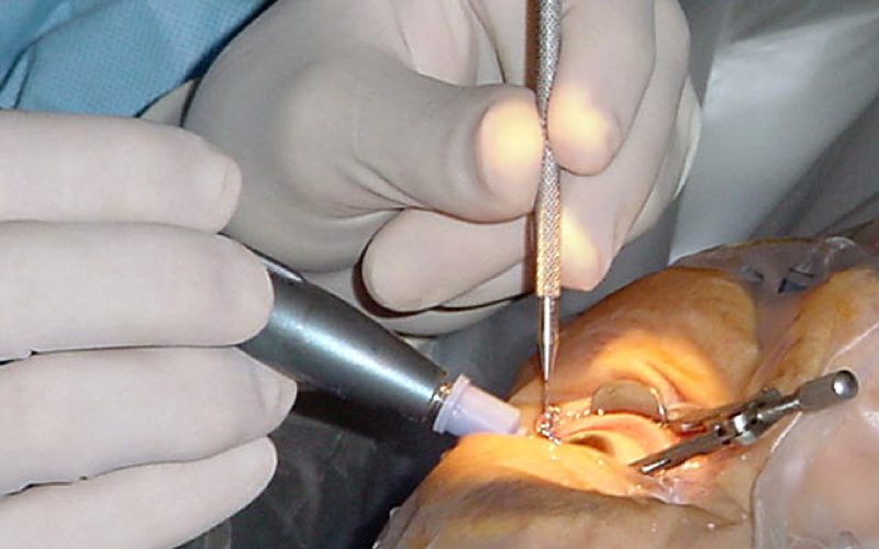030620-N-0000L-001
Portsmouth, Va. (Jun. 20, 2003) -- Cmdr. Gary A. Tanner, an ophthamologic surgeon at Naval Medical Center Portsmouth, inserts a synthetic lens into the eye of a patient following the removal of cataracts in her left eye.  Cataract removal surgery is just one of the services offered at Naval Medical Center Portsmouth.  U.S. Navy photo by Journalist 2nd Class Sarah Langdon.  (RELEASED)