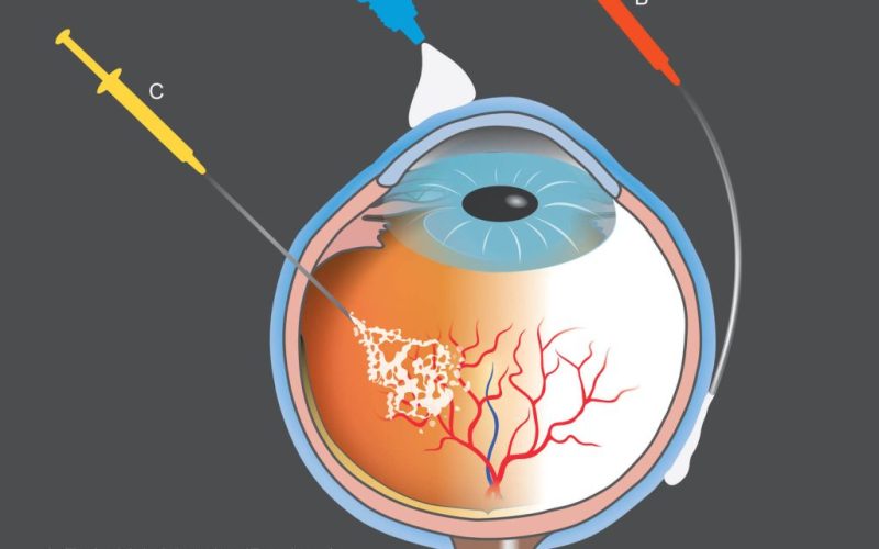 intravitreal-injection-opt-1024x921