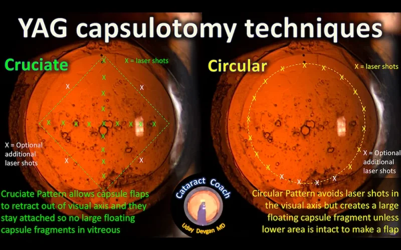 yag-capsulotomy-techniques
